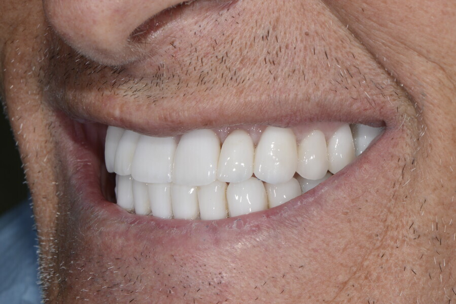 Fig. 27c: Left view of the patient’s final smile.
