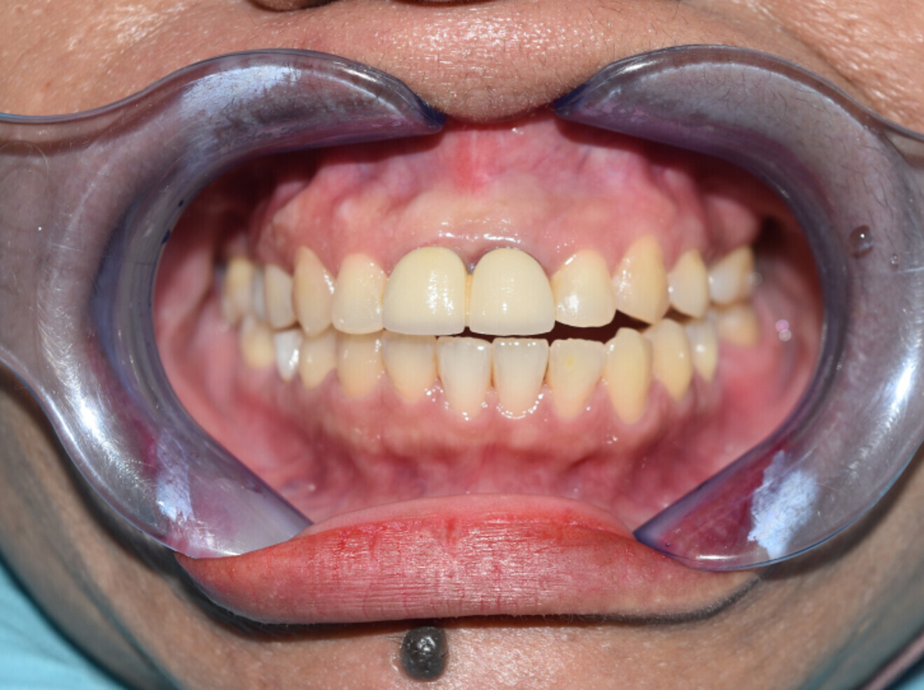 Fig. 13d: 6 years post  orthodontic treatment (Anterior open bite visible)