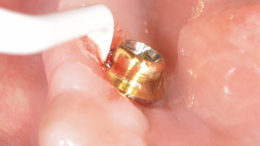 Fig. 8_Curettaggio manuale con strumenti dedicati.