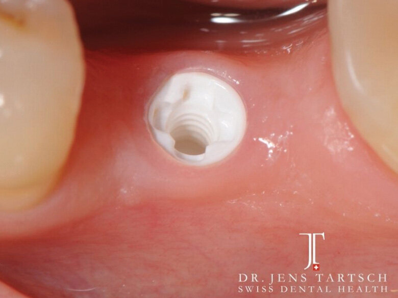 Fig. 8: ZERAMEX XT implant ready for impression. (Photo: Jens Tartsch, DMD)