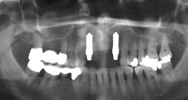 Vollkeramische Implantate – ein evidenzbasiertes Verfahren?