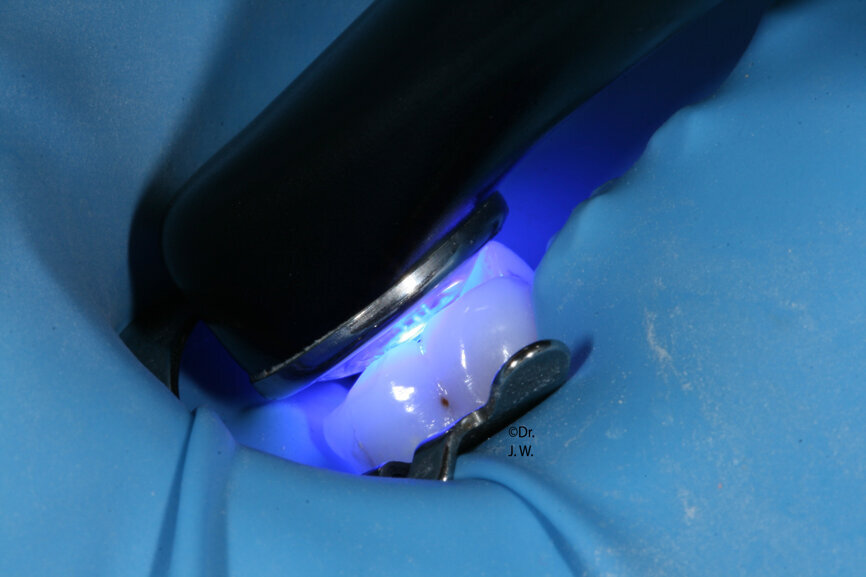 Geringer Platzbedarf bei Polymerisation im Molarenbereich. (Foto: Dr. Jörg Weiler)