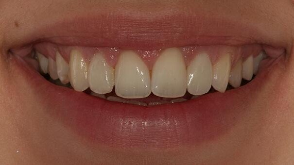 Conservative smile enhancement: Direct composite resin restoration of conoid lateral incisors