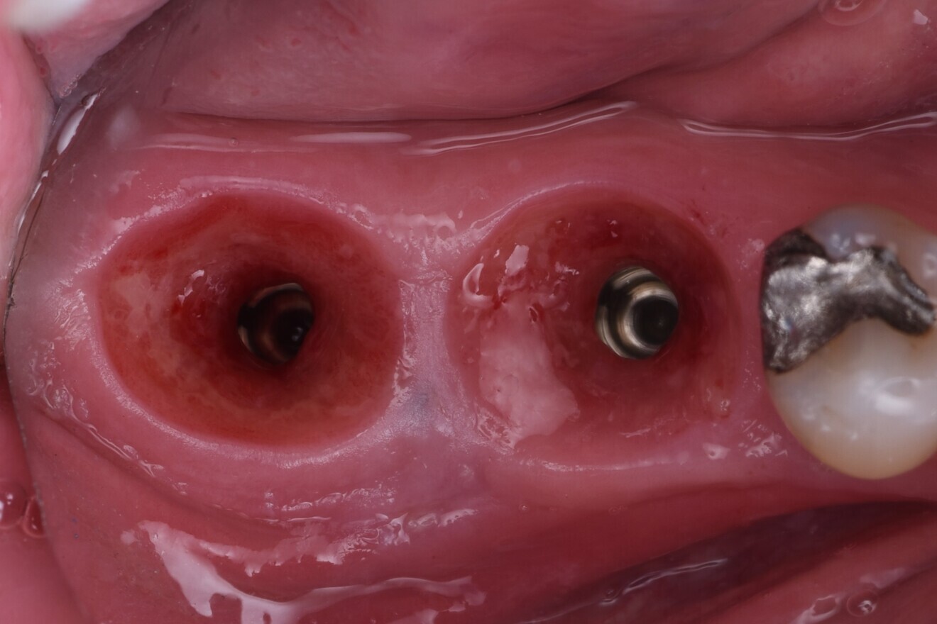 Fig. 13: Healing abutments removed to reveal soft-tissue healing. 