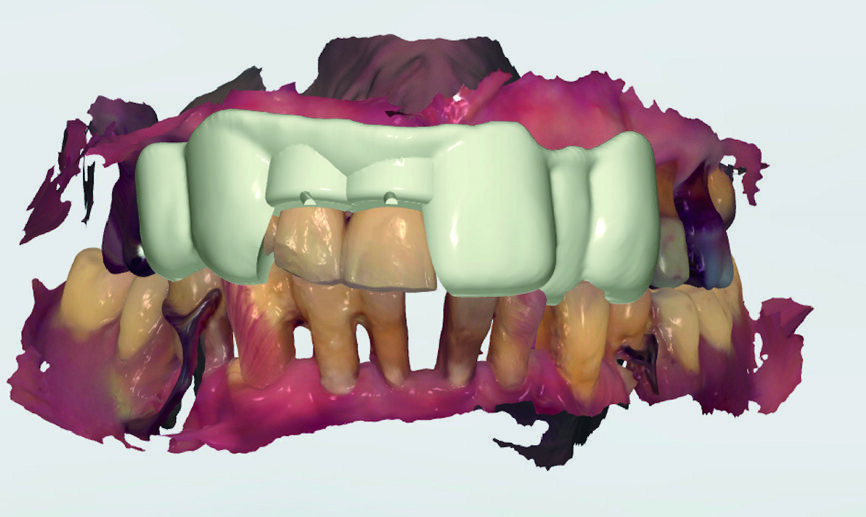 Fig. 4 : Guide chirurgical avant impression.