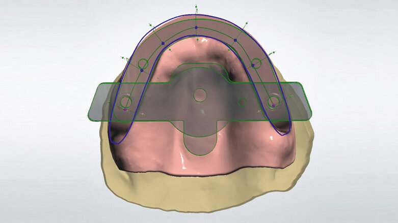 Digitální celkové náhrady