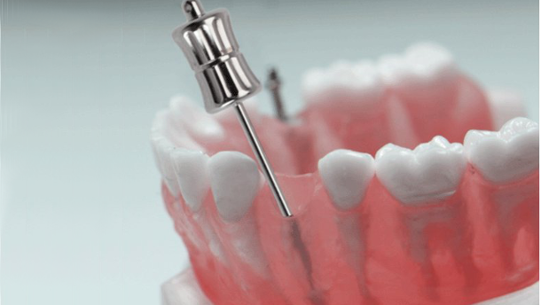 Nuevos extractores manuales para fragmentos de raíces