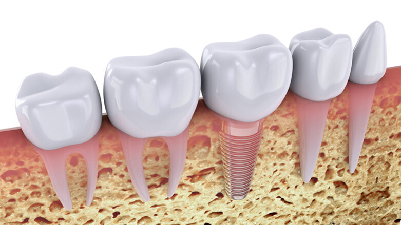 Zóny na CBCT čelisti