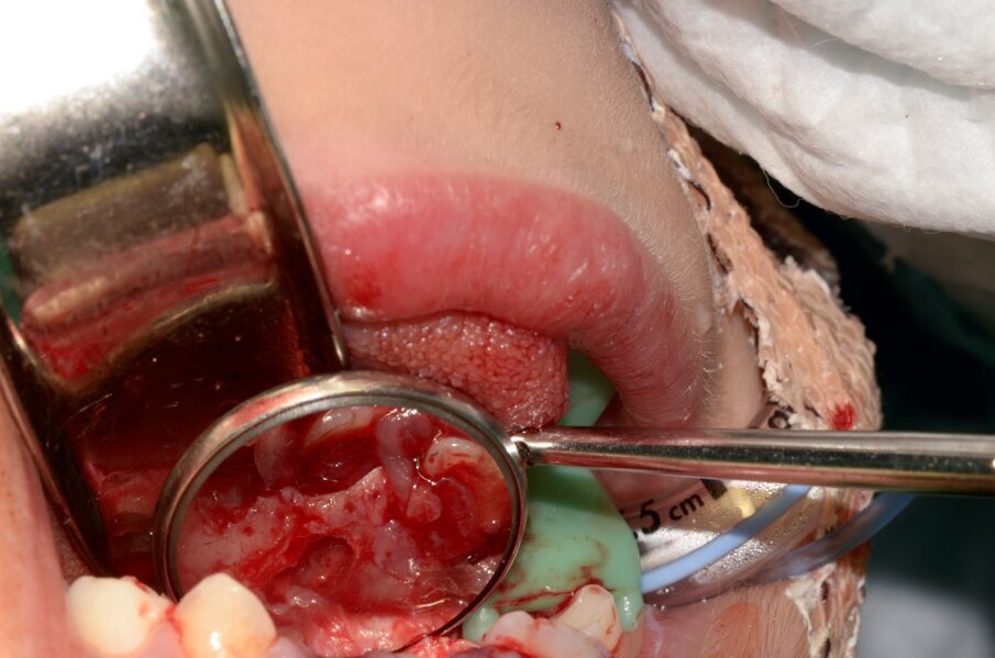 Fig. 9. A survey of the surgical site after irrigation and bone filing was made.