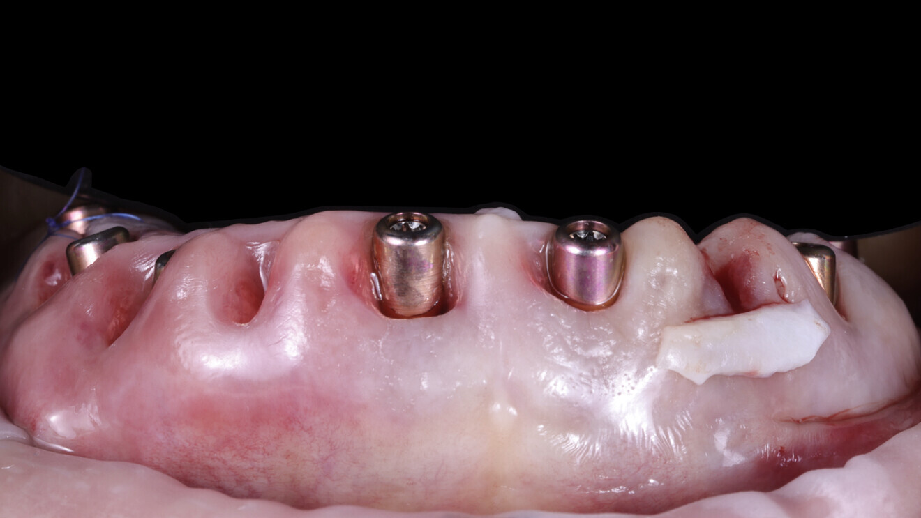Fig. 20: Connective tissue graft in the area of tooth #12 the day after implant placement.