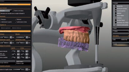 Réhabilitation totale Zircone Prettau® sur piliers implantaires télescopes avec le système CAD/CAM 5-TEC Zirkonzahn