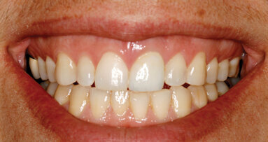 Restorative-driven implant dentistry: The future is now