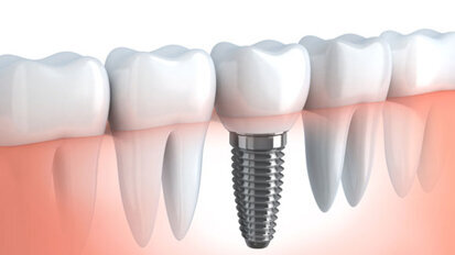 Zur Lage der Implantologie in der Schweiz Zur Lage der Implantologie in der Schweiz