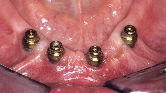 Implant planning affects periimplant diseases: A time shift link
