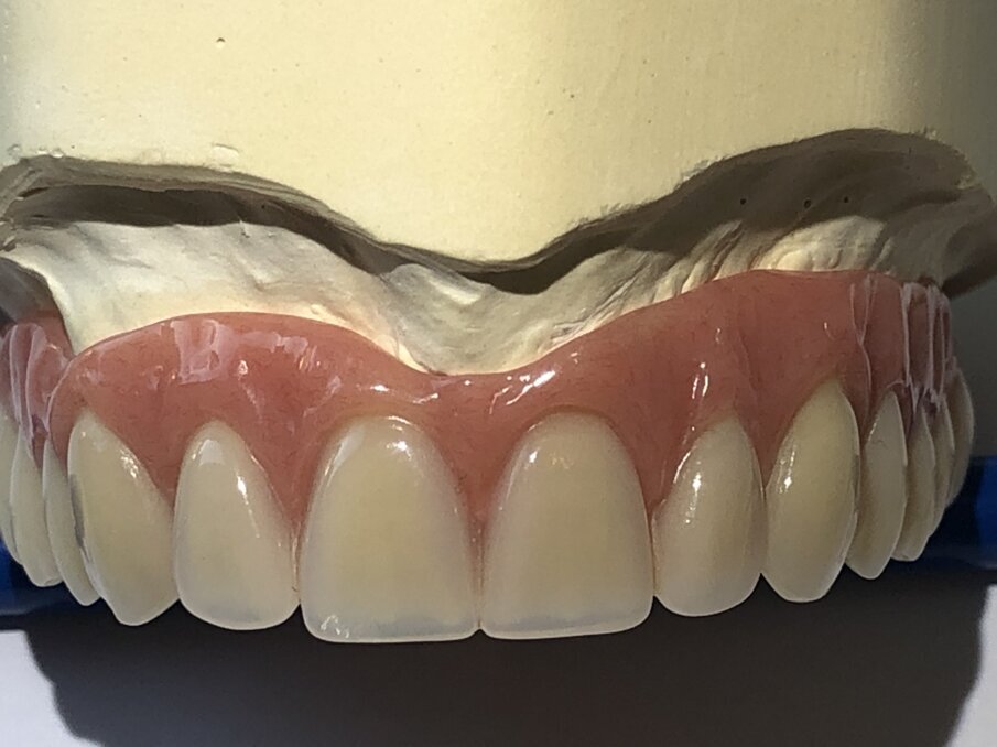 Afbeelding 16. Frontaal aanzicht prothese met minimale protheseranden.