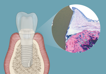 Patent Dental Implant System