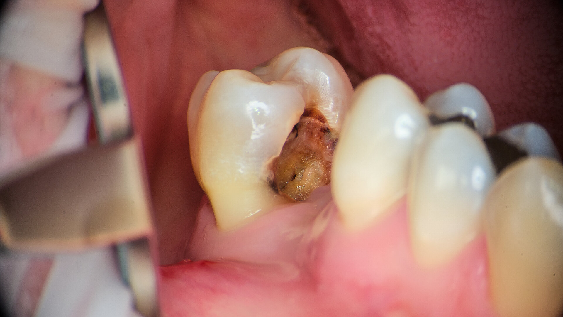 A novel approach to root canal preparation: The in–out technique