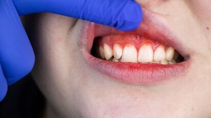 Kinderen met immuundeficiënties hebben meer kans op het ontwikkelen van parodontitis