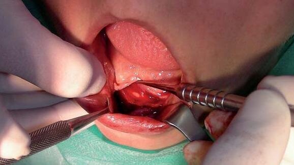 Miniimplanty systemu Bego-Semados na przykładzie klinicznym