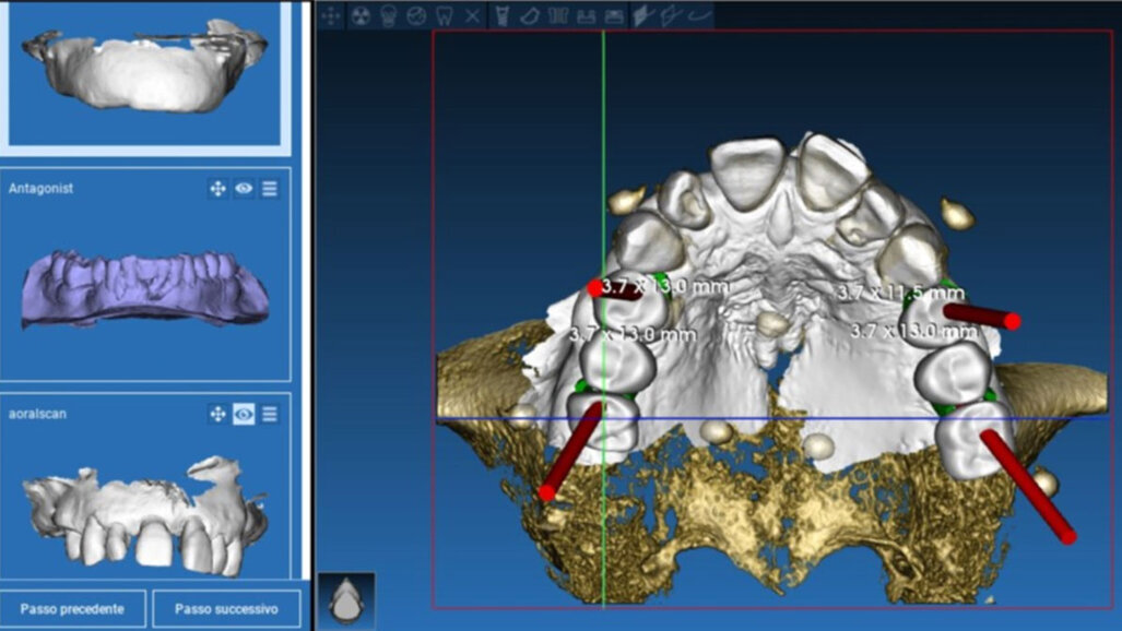 Implantologia guidata con flusso digitale completo in house