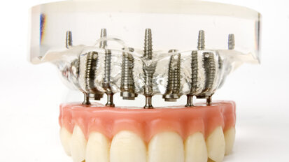 Implanteren in bovenkaak tegen kaakbotslijtage