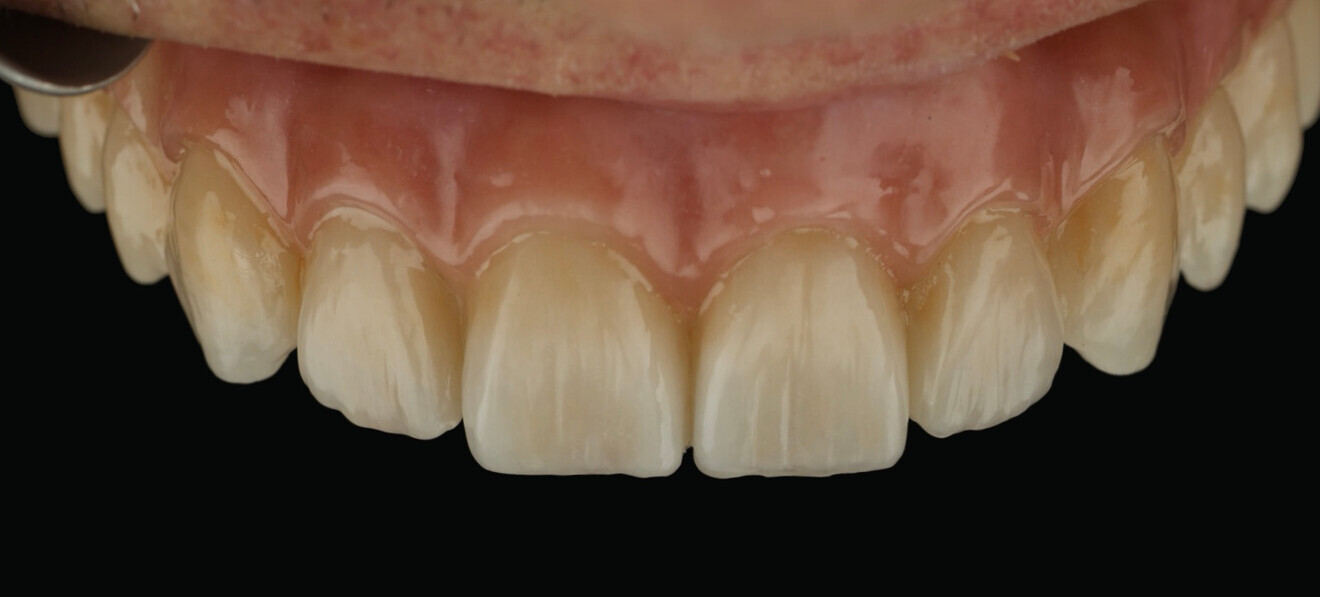 Fig. 7: Intra-oral view. 