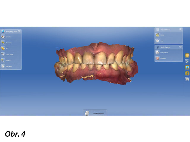 Buccal scan – informace o vztahu horní a dolní čelisti – nezbytný při navrhování budoucí korunky.