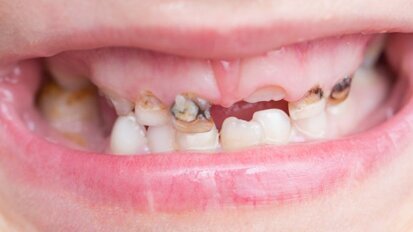 Potrzebna Strategia Walki z Próchnicą wśród Dzieci