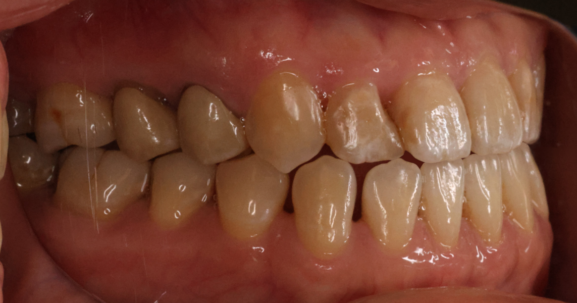 Figs. 9a–e: Intra-oral photographs after the first phase of treatment.
