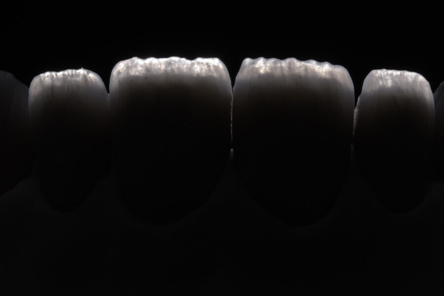 Fig. 12: Incisal effects after firing.