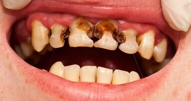 6 sposobów na próchnicę