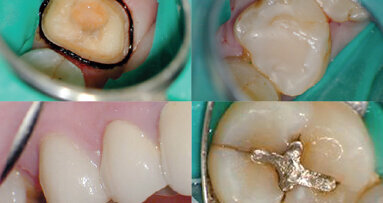 Techniky preparace na korunku za použití dentálního operačního mikroskopu