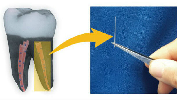 Sperimentati dagli scienziati nuovi biomateriali a base di “microdiamanti” per la terapia canalare