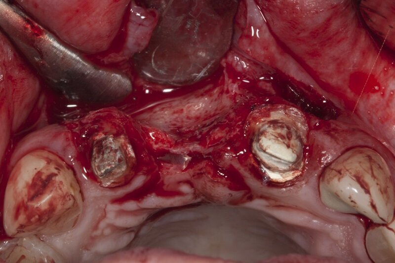 Ryc. 11_Zabieg regeneracji kostnej.