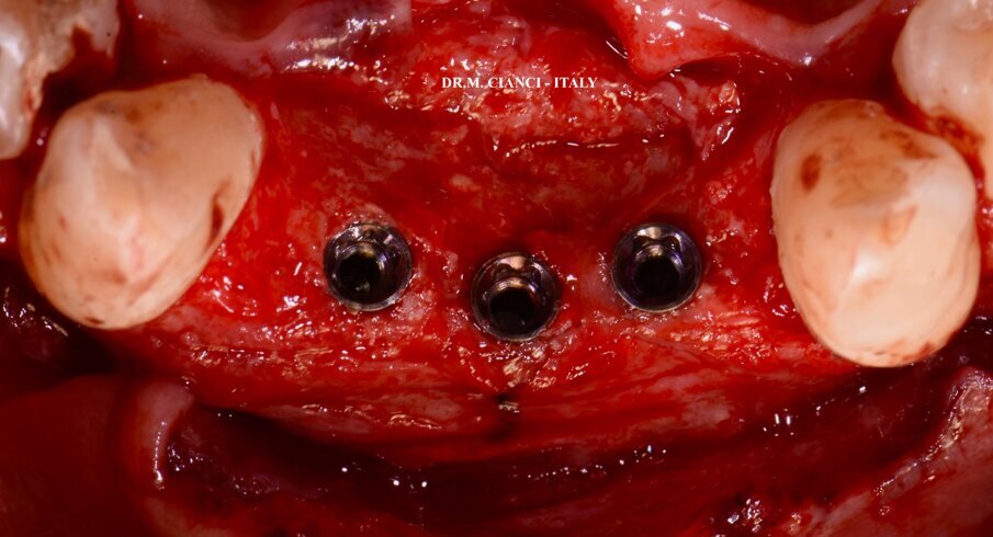 Fig. 5 - Impianti BTI Narrow 3.0 a connessione interna esalobulata.