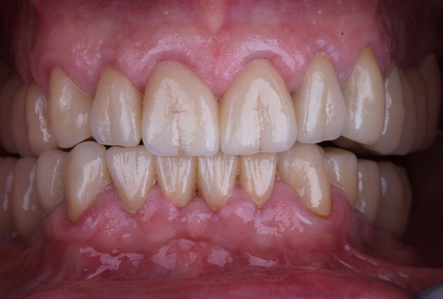 Fig. 29: Evaluation of the functional parameters, here in laterotrusion