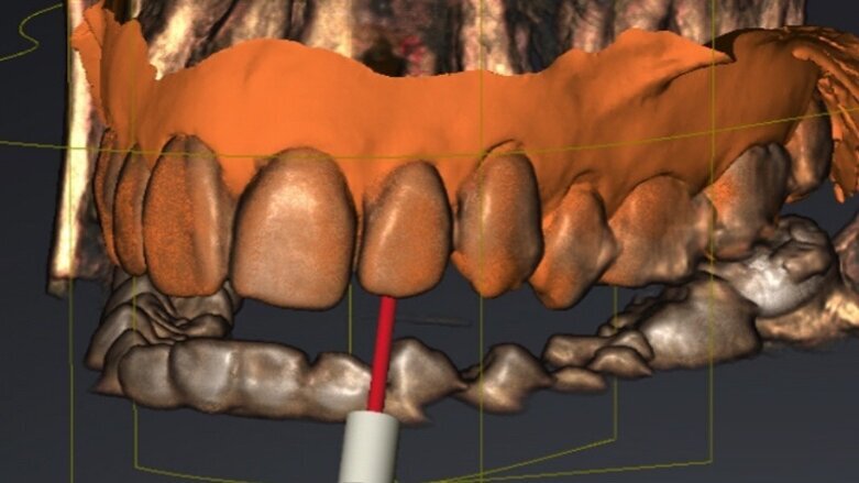 Calcified canals: A new approach to an old problem
