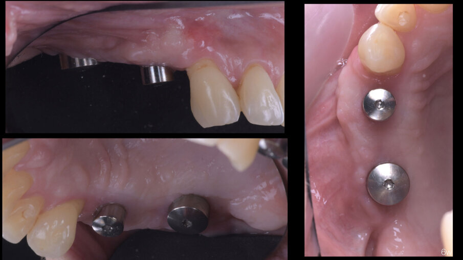 Fig. 16 - Guarigione clinica a 6 settimane.