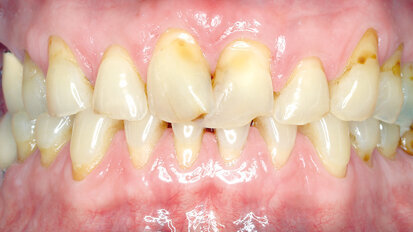 Vita Suprinity: un caso clinico