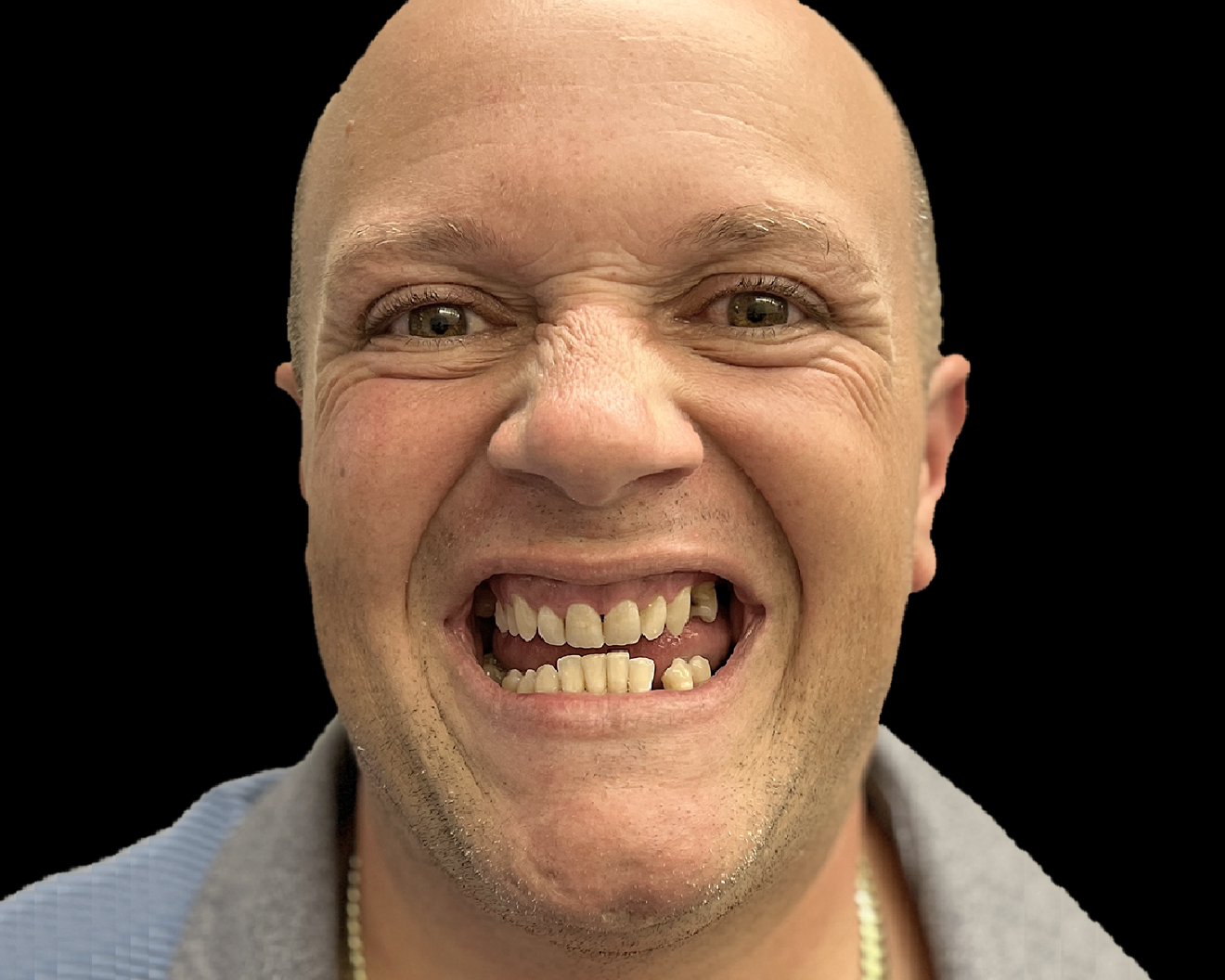 Fig. 11e: Pre-op photograph showing a reverse curve of the mandibular teeth and poor aesthetics. 