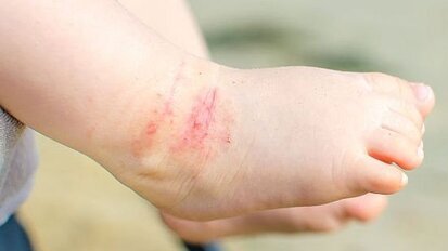 Kinderen met eczeem hebben meer kans op cariës