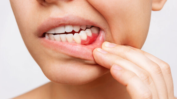 Salivary biomarkers reveal link between periodontitis and metabolic syndrome risk