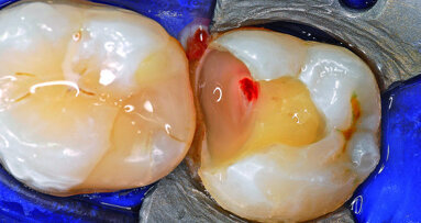 3D Endo Software, glide path management and WaveOne Gold