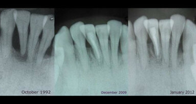 La placca dentale può essere utilizzata per il trattamento e la previsione delle malattie