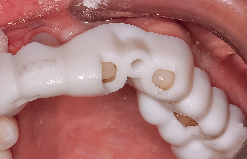 Fig. 7a: A sleeveless guide to accommodate a 2 mm long pilot drill that was used to reach the root apex.