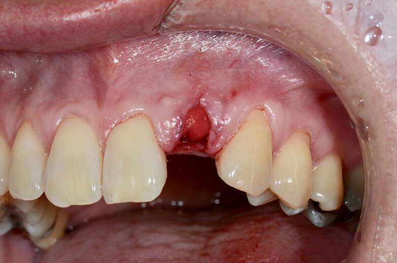 Fig. 4: Grafting material placed into the extraction socket and covered with a non-cross-linked collagen membrane. 