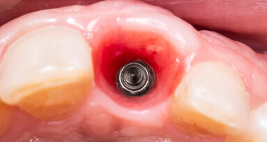 Experts agree on standards for clinical treatment of peri-implant soft tissue
