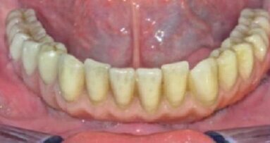 Stałe uzupełnienie protetyczne pełnego łuku zębowego, bez metalu, na czterech krótkich implantach