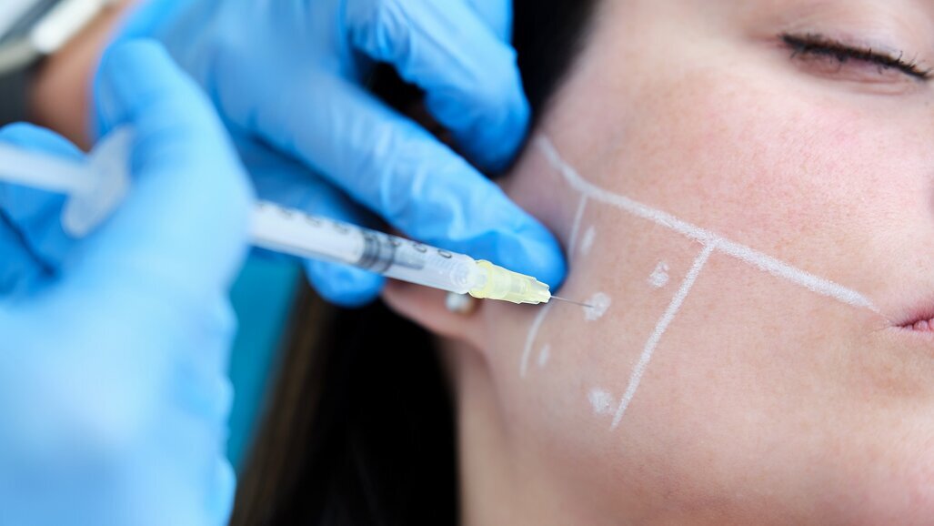 Orthodontics and botulinum toxin: Integrated care of a patient with bruxism and occlusal alteration