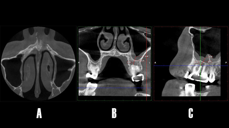 Resolución de sinusitis maxilar odontogénica mediante cirugía periapical